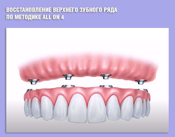 Имплантация All on 4: восстановление верхнего зубного ряда по методике "Все на 4-х"