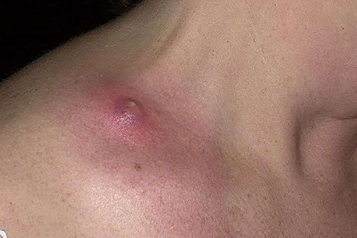 гнойная шишка на груди у женщин фото 106