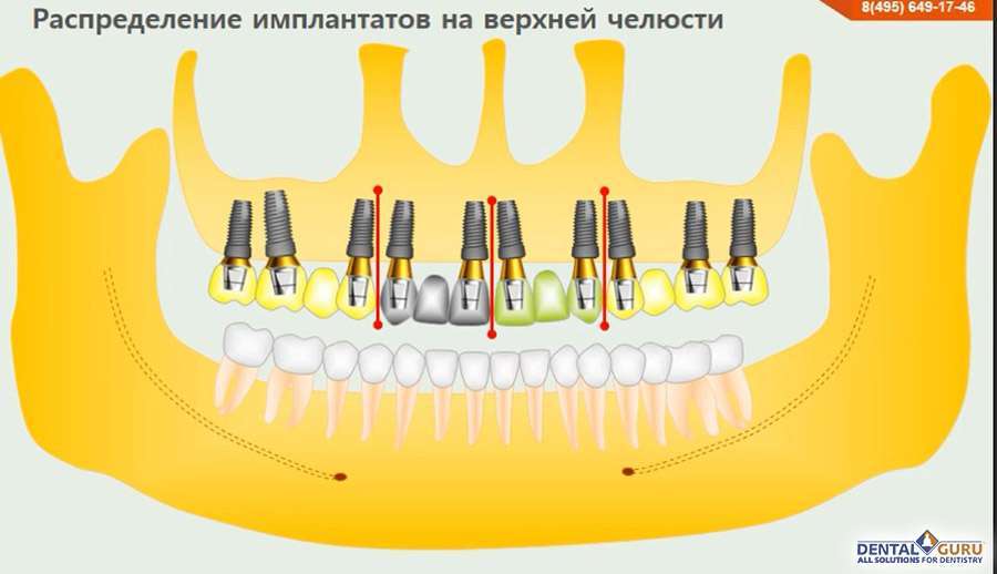 Схема установки имплантов зубов на нижней челюсти