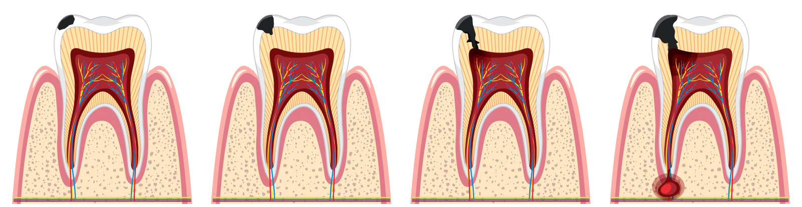 этапы развития гранулемы зуба