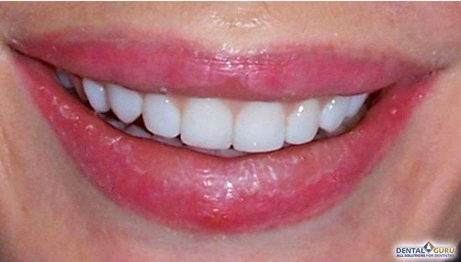 композитное отбеливание зубов 1-5