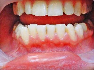 Синдром венсана в стоматологии это thumbnail