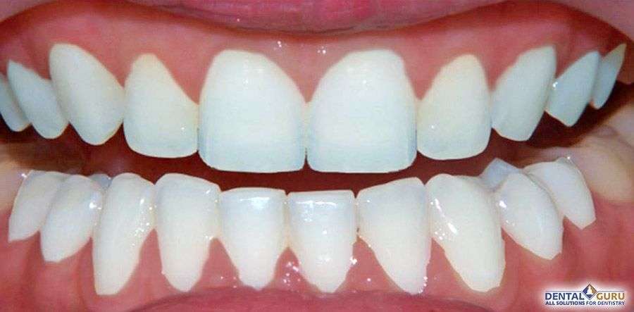 композитное отбеливание зубов 1-4