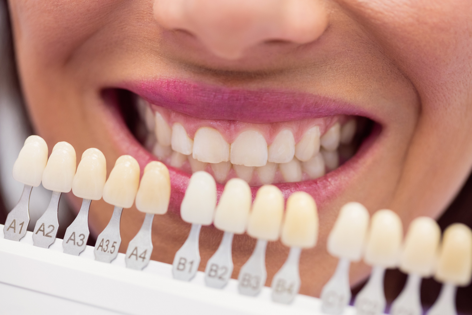 Отбеливание зубов - методы, противопоказания