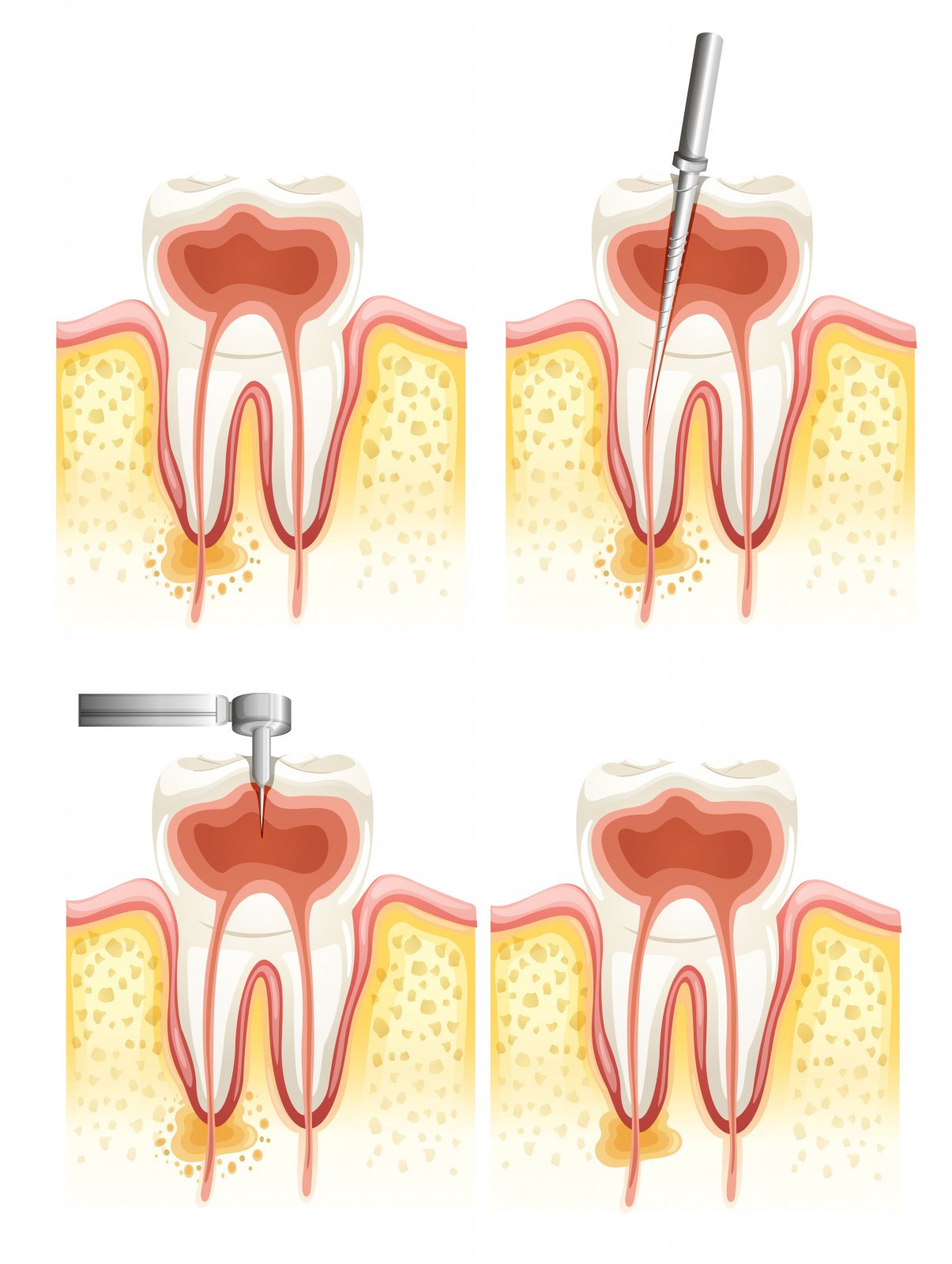 этапы лечения зубных каналов