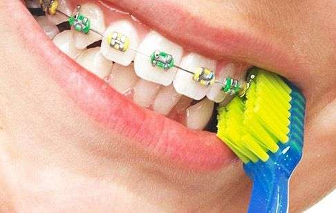 ортодонтические зубные щетки
