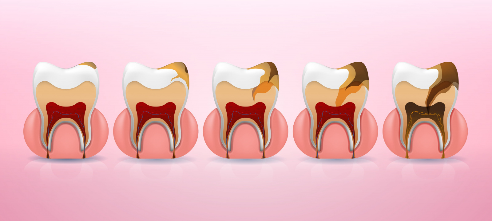 стадии развития кариеса зуба