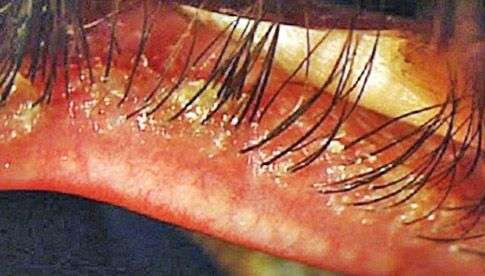 Фото 2. Глазной клещ – симптомы блефарита.
