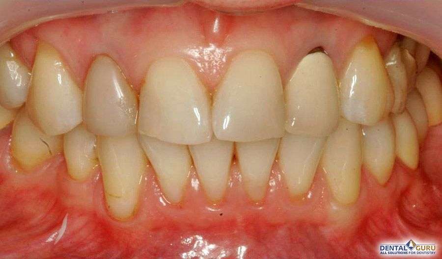 Отбеливание зубов 2-3