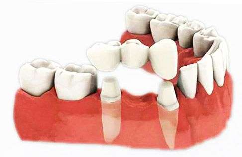 импланты на 2 зуба
