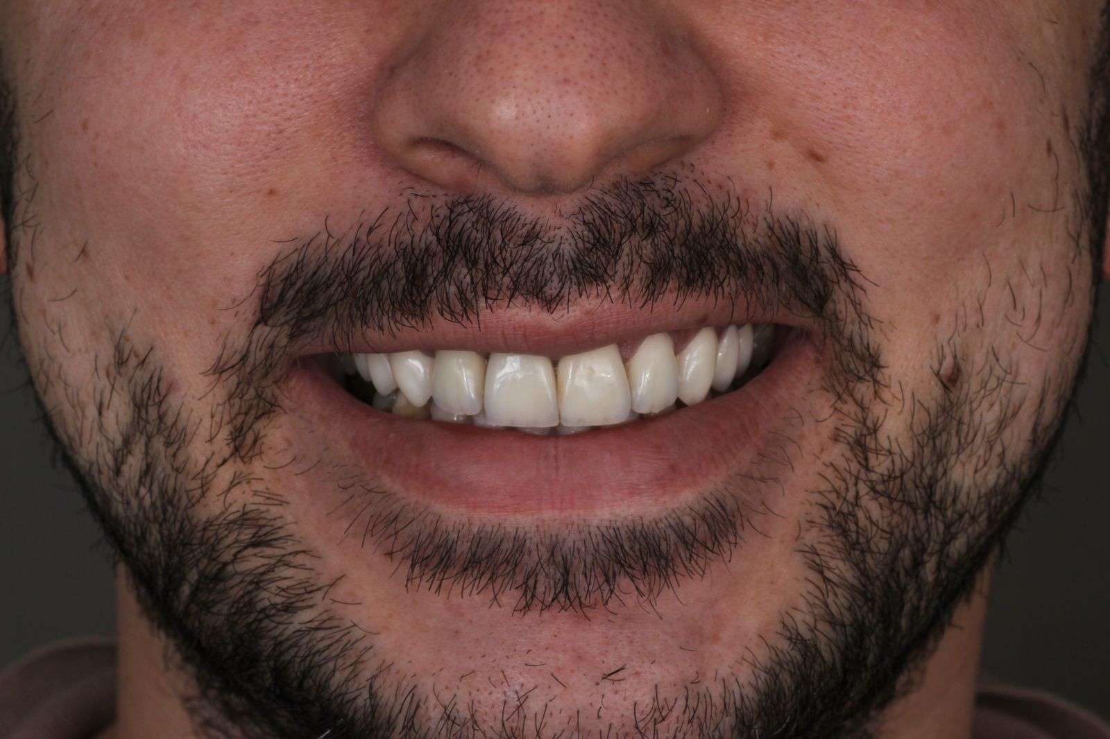 Пример тотального преображения улыбки с помощью современных керамических реставраций
