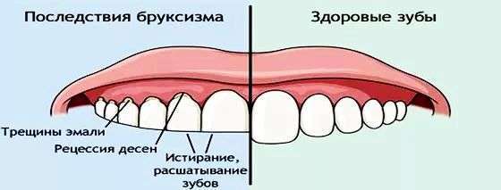 Почему во время сна скрипят зубами thumbnail