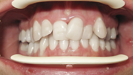 Макродентия зубов