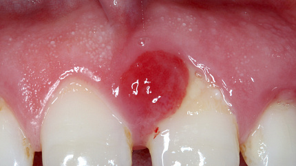 Гранулема зуба – скрытая угроза