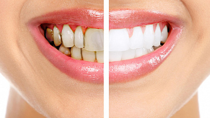 Тетрациклиновые зубы: есть ли шанс вернуть белизну?